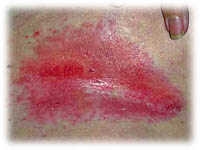 Svampinfektion �r en hudsjukdom
