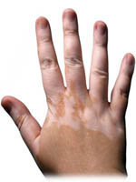 Vitiligo är en hudsjukdom